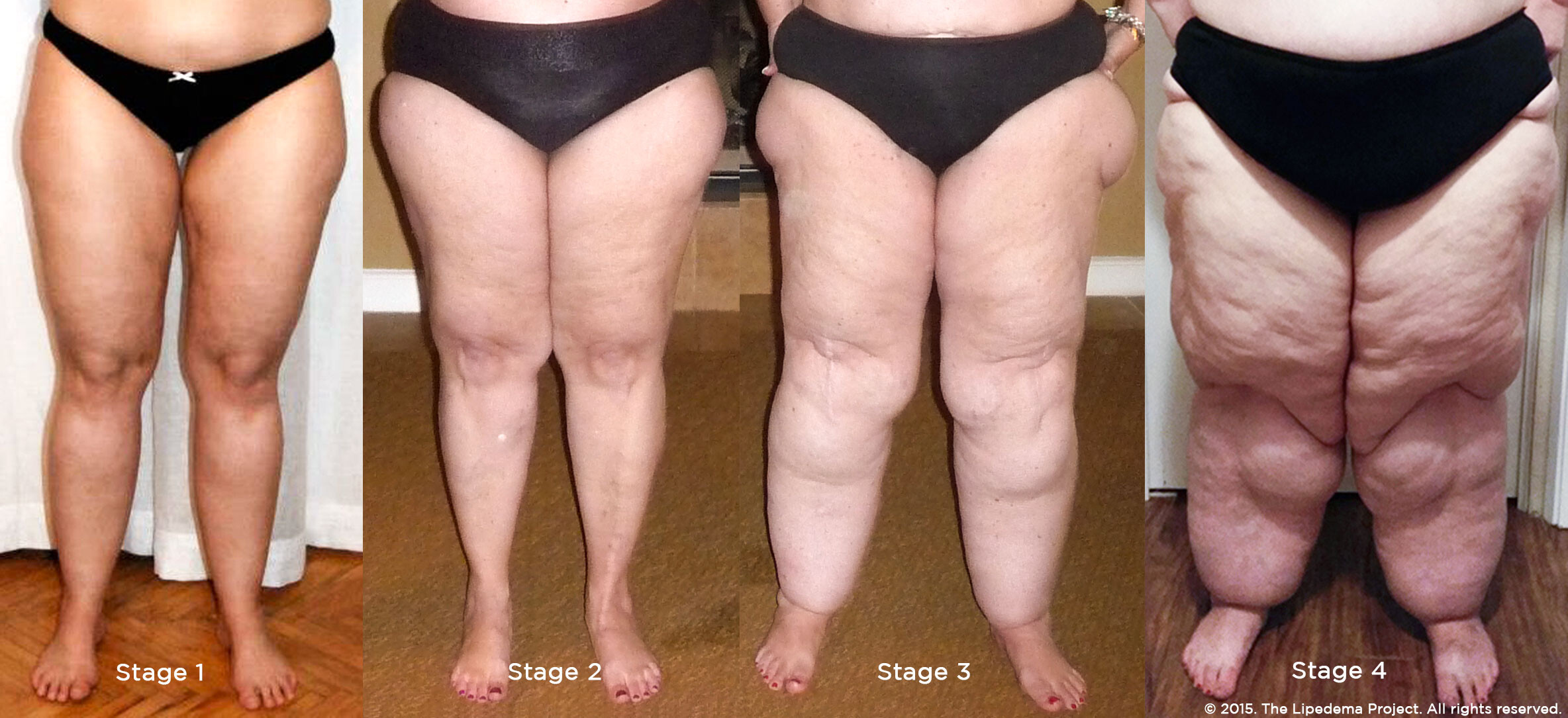 What you Need to Know About Lipedema - Tactile Medical